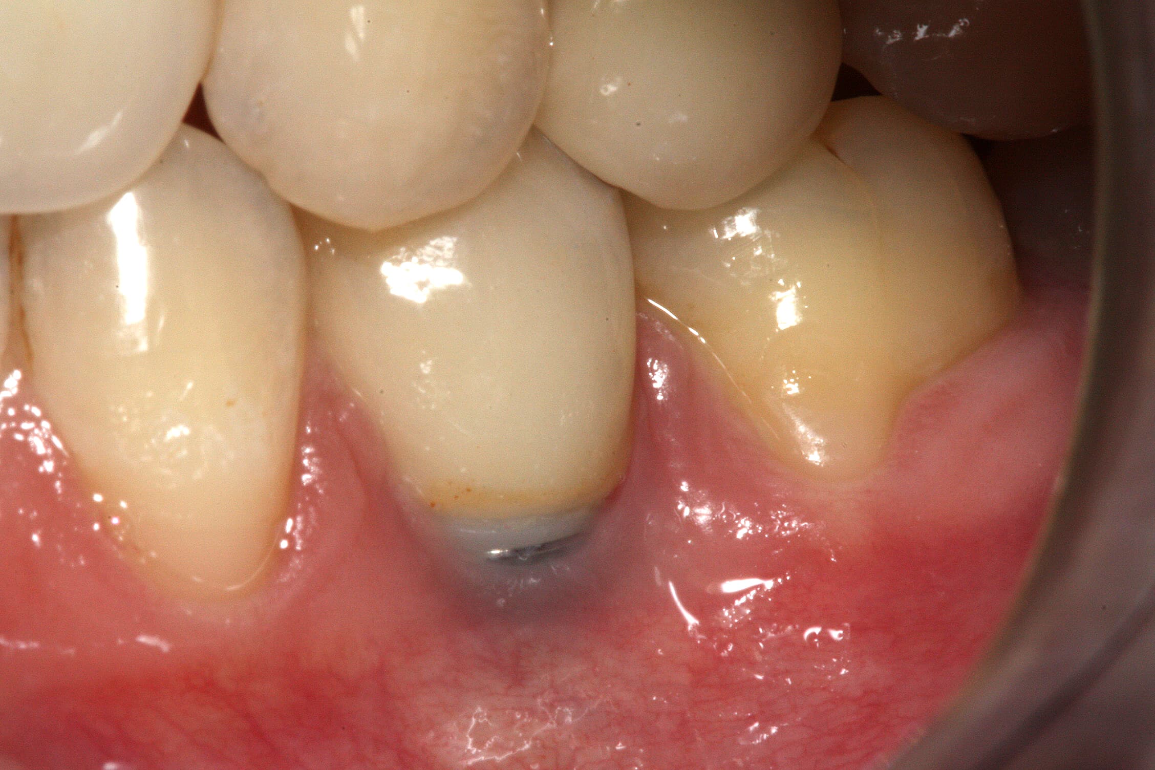 Clinical example of gingival recessionClinical close up showing gingival recession around a dental implant, with the metal abutment visible.